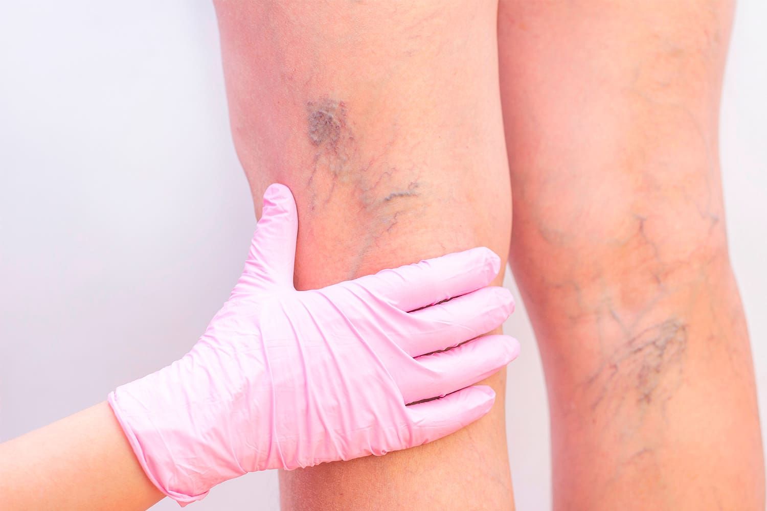 ¿por qué se hinchan más las piernas en verano?