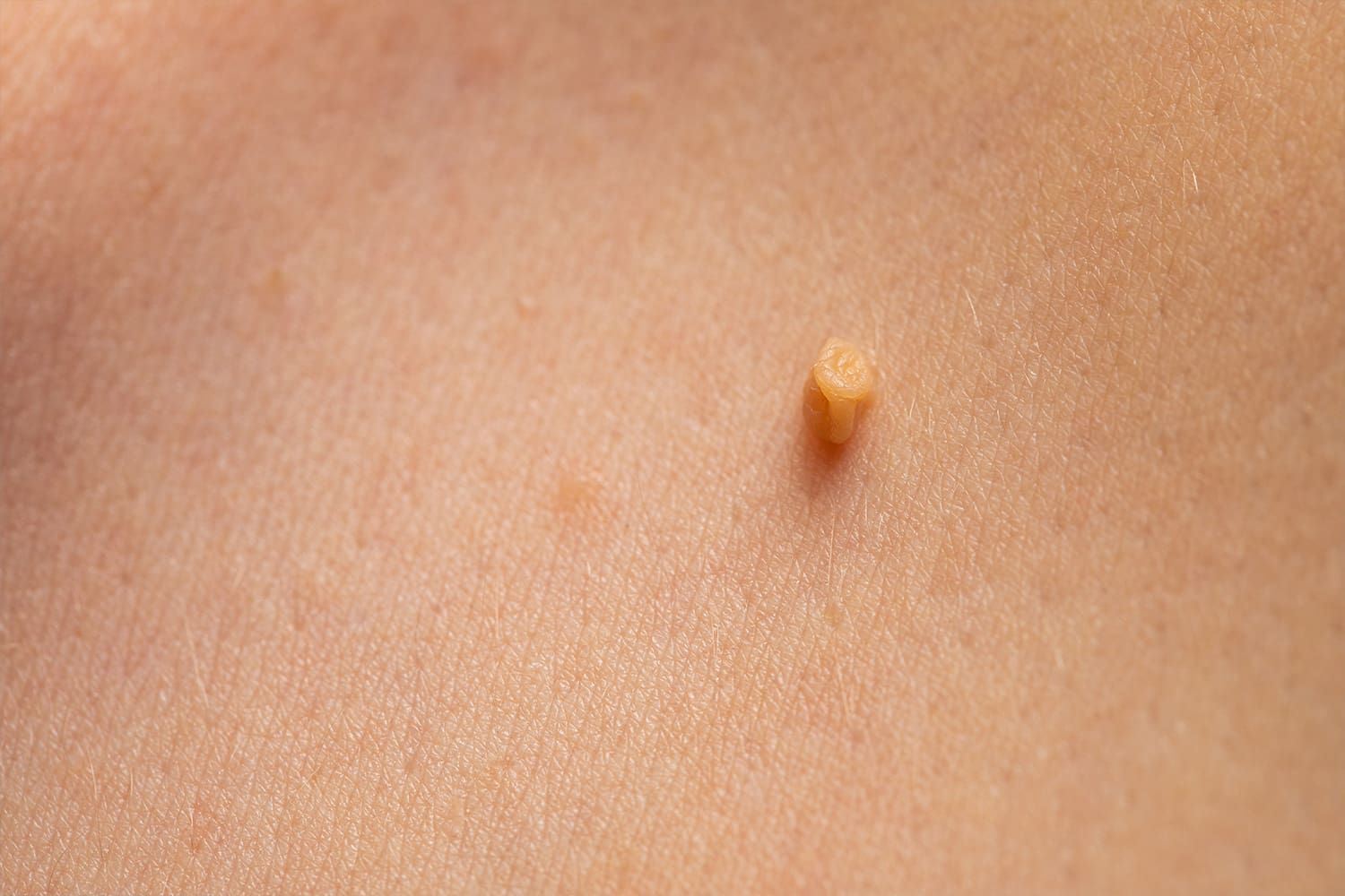 prevención cáncer cuello uterino