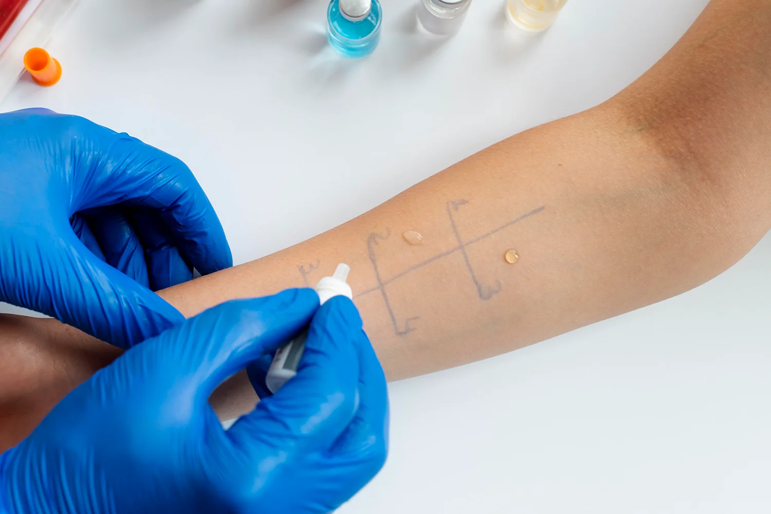 Prick Test La Gu a Definitiva Sobre Las Pruebas De Alergia En La Piel Prick Test La Gu a Definitiva Sobre Las Pruebas De Alergia En La Piel